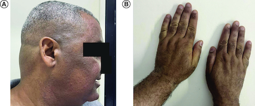 Figure 2. Improvement of hyperpigmentation after vitamin B12 therapy.(A) Of the face and (B) hands.