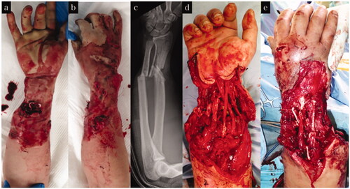 Figure 6. Treatment course of case 3. (a,b) Appearance on arrival at our hospital. (c) X-ray on arrival at our hospital. (d,e) Appearance after tendon reconstruction using pull in suture.