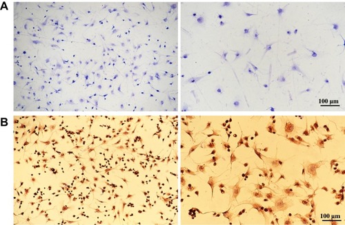 Figure 1 Identification of human primary chondrocytes. (A) Toluidine blue staining of human primary chondrocytes, and proteoglycans in chondrocytes were stained purple. Scale bar, 100 μm. (B) Collagen II immunohistochemical staining of human primary chondrocytes.