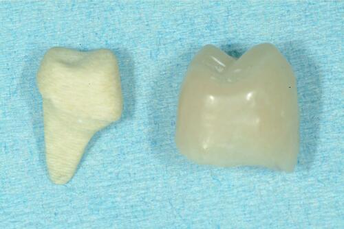 Figure 4 Photography of post and core, and provisional composite resin crown.