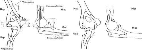 Figure 1. The Wrightington method for measurement of radiolucent lines (RLLs) and position of the Souter-Strathclyde total elbow prosthesis.The RLLs are divided into zones and are scored in two directions (anteroposterior and lateral direction).