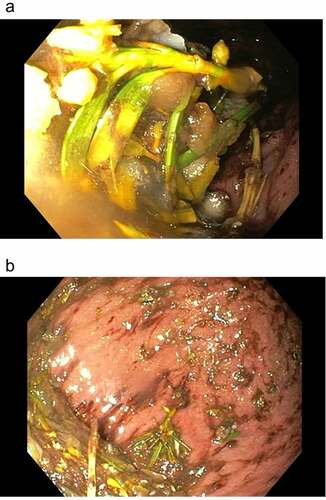 Figure 3. Gastroscopy showing copious foliage of Taxus baccata.