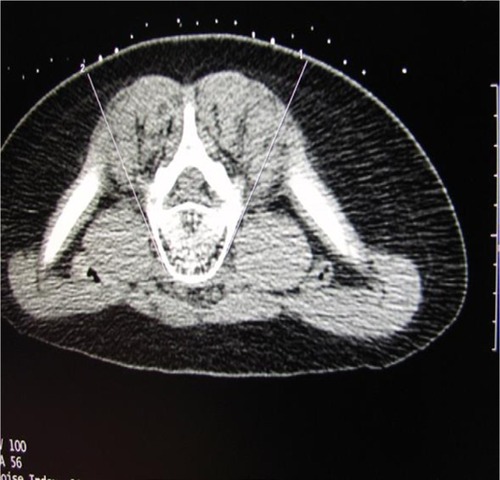 Figure 7 Radiographic image of the indicators from the marking grid, which are seen externally to the patient, and needle trajectory as seen with axial CT imaging.