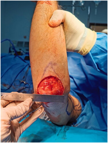 Figure 1. Left elbow defect following wide local excision of a Merkel cell carcinoma lesion.