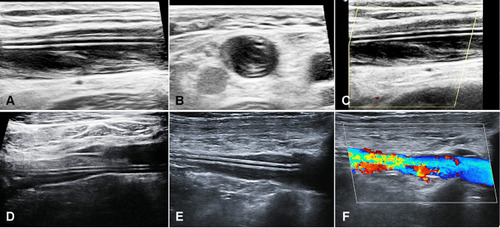 Figure 4 Ultrasound examination of PICC-related VTE. (A–C) show that the basilic vein with PICC-related superficial venous thrombosis was completely occluded and uncompressed without any color signal after 2 weeks of anticoagulation therapy. (D–F) show that the subclavian vein with PICC-related deep venous thrombosis was partially occluded, but was recanalized and filling with blood flow after 2 weeks of anticoagulation therapy.