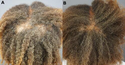 Figure 12 Central vertex of Patient 4 Images of the central vertex of a patient with central centrifugal cicatricial alopecia obtained before (A) and after (B) 13 months of treatment with Gashee lotion and oral supplements are shown.