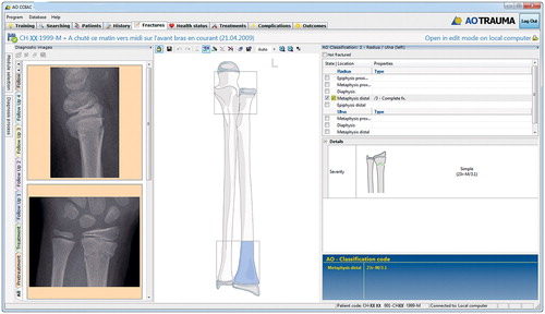 Figure 2. Screen shot of the AOCOIAC interface with documentation of a distal radius fracture caused by a fall.