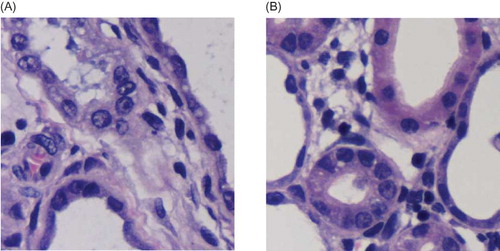 Figure 7. HE staining. (A) In negative control group, renal tubular structure was severely damaged, that is, collapsed lumen, diffusive infiltration of fibroblast in renal interstitium, and collagen formation. (B) In contrast, kidney in silence group appeared alleviated dilation of renal tubules, thinner renal interstitium, and less interstitial collagen deposition.