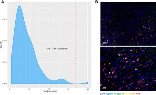 Figure 2 Tumor microenvironment of this patient. (A) Targeted next-generation sequencing analysis (483-gene panel) showed high tumor mutation burden (33.571 muts/MB). (B) Multiplex immunofluorescence staining results.