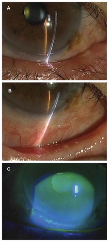 Figure 5 Photograph 3 months postoperatively. (A) The conjunctivochalasis has resolved. Ocular irritation has decreased to 10% of the preoperative level. (B) White scar tissue has formed in the area of coagulation, but is inconspicuous. (C) Photograph obtained 3 months postoperatively showing fluorescein staining. The single tear meniscus is restored and the watery eye has resolved.
