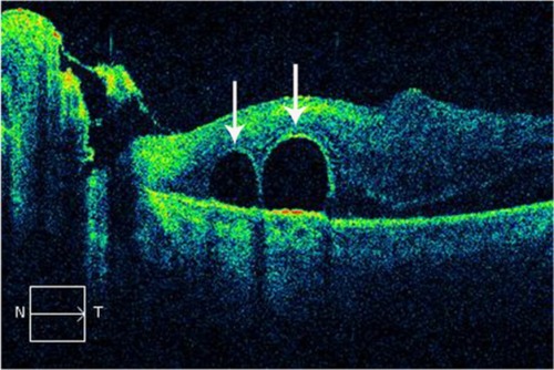 Figure 63 Spectral-domain Cirrus™ optical coherence tomography image demonstrates the presence of two subretinal bubbles of perfluorocarbon liquid (white arrows) after vitreoretinal surgery.