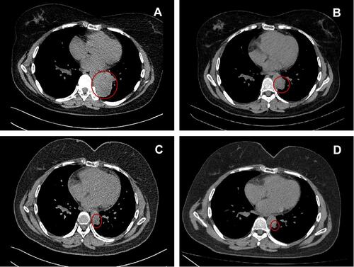 Figure 2 Radiological imaging of the patient before and after the combination treatment of olaparib, pembrolizumab, and bevacizumab. (A) Computed tomography (CT) performed on December 4, 2020, showing recurrence before treatment (baseline). (B and C) CT performed on March 17, 2021 (B) and May 31, 2021, (C) showing the reduced tumor size after four and eight cycles of combination therapy, respectively. (D) CT performed on December 2, 2021, identified little residue of the tumor. The red circle indicates the tumor.
