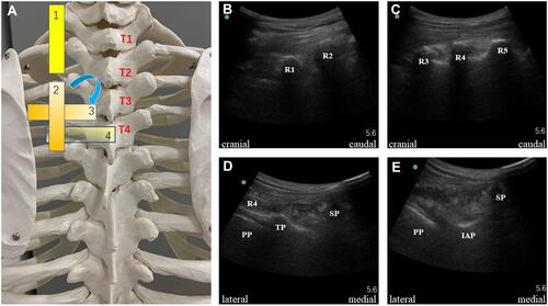 Figure 1 Four-step confirmation of the thoracic segment confirmation. (A) Schematic diagram of the placement of the ultrasonic probe. (B) The first step was to confirm the first rib. The ultrasound probe was placed in the paraspinal sagittal position of the spine and then moved cranially to caudally. The first hypoechoic shadow was the first rib. (C) The second step was to confirm the target rib. We moved the probe cranially to caudally and placed the target rib segment in the center of the ultrasound image. (D) The third step was to rotate the ultrasound probe 90 degrees to form a transverse axis with the spine and display the transverse process, rib, and the PP on the ultrasound image. (E) The fourth step was to move the probe parallel from the cranial to the caudal region to hide the transverse process and reveal the IAP image. The IAP cortex showed a linear hyperechoic image under ultrasound.