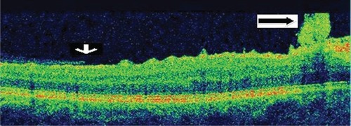 Figure 9 Close up view of horizontal optical coherence tomography scan just above the foveal plane showing edge of ruptured epiretinal membrane (ERM) (white arrow) temporally and rolled-over hyper-reflective ERM nasally (black arrow).