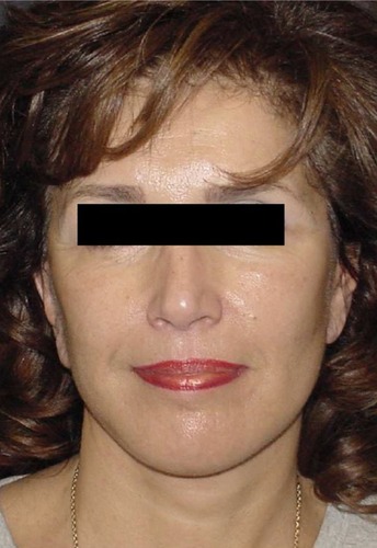 Figure 9 Appearance 15 days postoperatively. The two different types of fibrin glue were used on the two sides of the face with comparable results.