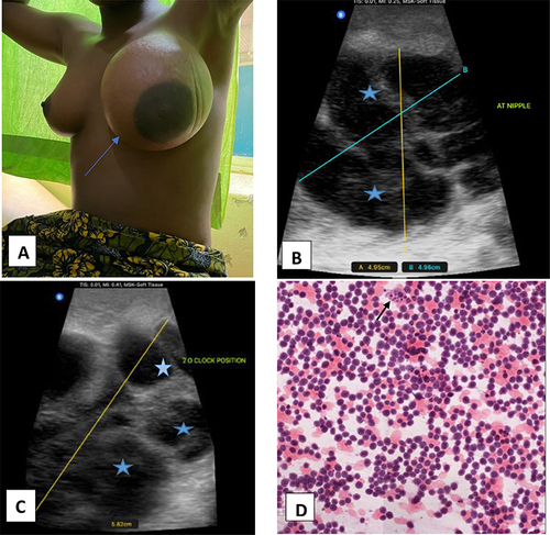 Figure 1 (A) shows a diffusely swollen left breast with shiny skin (blue arrow). (B and C) are ultra-sonographic images of the breast showing multiple large hypoechoic masses (blue stars) (4.95cm by 4.96cm and 5.82 cm) respectively, regularly shaped with no calcifications. (D) shows a touch imprint with medium-sized cells, coarse chromatin, and occasional tingible body macrophages (see black arrow).