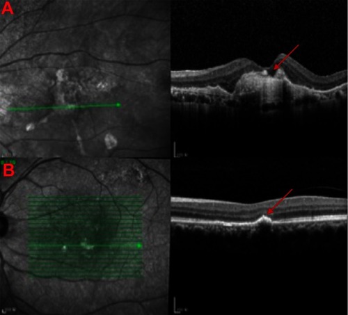 Figure 1 Clinical manifestations of age-related macular degeneration. (A) Images of optical coherence tomogram (OCT) (above) of choroidal neovascularization (CNV). Continuity of the retinal pigment epithelial is destroyed with local thickening and protuberance (red arrow). (B) Images of OCT of drusen (below) (red arrow).