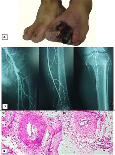 Figure 2 Case 2, (A) gangrene of forefoot; (B) angiography characteristics for Buerger’s disease; (C) organized thrombus in medium and small sized vessels along with intima thickening and infiltration of inflammatory cells in all layers of the vessels and are suggestive for Buerger’s disease.