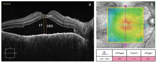 Figure 1. Representative optical coherence tomography images of the fovea. (a) The horizontal B scan was used to manually measure foveal thickness (FT), serous retinal detachment (SRD), and sensory retinal thickness (SRT). (b) The macular cube scan was used to automatically measure the central fovea thickness (CFT), cube volume (V) and cube average thickness (AT) .