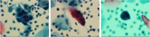 Figure 2 Abnormal SurePath Pap test cells interpreted as “high-grade squamous intraepithelial lesion” (original magnification 400×); residual SurePath vial fluid tested negative using the Hybrid Capture 2 test for high risk human papillomavirus.