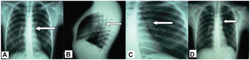 Figure 1 Chest radiographs: (A and B) before treatment with arrow showing a left perihilar shadow, (C) After treatment (surgery) arrow indicates (D) staples on 5-year follow up.