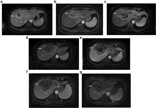 Figure 1. The change of enhanced computed tomography of liver.