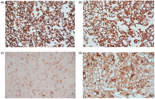 Figure 3 Light microscopy photographs of immunohistochemistry staining study of the tumor cells show (a) cell membrane positivity to CK CAM 5.2, (b) cell membrane positivity to CK 19, (c) cell membrane positivity to EMA and (d) cell membrane positivity to S100. (All magnifications are ×200).