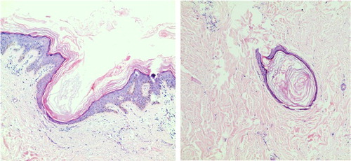 Figure 5. Chloracne. Histopathology of comedone-like lesions on back showed epidermal hyperplasia, mild papillary hyperplasia and pseudo-angle cyst (HE 100×).