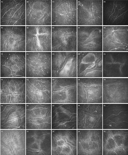 Figure 3 In Vivo Confocal Microscopy (IVCM) Images of Post-Vitrectomy Ocular Changes. The provided IVCM images capture the post-vitrectomy alterations in dendritic cells (DCs) and corneal subbasal nerve plexus (SNP) patterns in patients with retinal diseases under different vitrectomy procedures. Columns, sequentially from left to right, depict changes pre-surgery, and at 1, 3, 6, 9, and 12 months postoperative. A1-A5 series corresponds to a 60-year-old male treated with vitrectomy and C3F8 tamponade for retinal detachment. B1-B5 is from a 57-year-old female who underwent phacoemulsification, intraocular lens insertion, and vitrectomy with C3F8 tamponade for vitreous hemorrhage. C1-C5 represents another 57-year-old female treated with phacoemulsification and vitrectomy using C3F8 for a macular hole-related retinal detachment. D1-D5 captures the progression in a 47-year-old male post phacoemulsification and vitrectomy with SiO2 tamponade for retinal detachment. E1-E5 documents a 50-year-old male treated with vitrectomy and SiO2 for a macular-related detachment. Lastly, F1-F5 shows a 39-year-old female post vitrectomy with an air tamponade for an epiretinal membrane. The evident increase in DCs and corneal modifications emphasize the surgery’s lasting influence on ocular health.