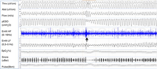 Fig. 2 Example of a 5-min polysomnography period. At the beginning of the sheet, respiratory movements are stable; flow channel shows slight flow limitation and mouth breathing. Negative esophageal pressure is increased up to −30 cm H2O. Emfit high-frequency channel shows multiple spikes. At the middle of sheet (marked with a black arrow) is a short arousal with opening of upper airway, normalizing esophageal pressure values and cease of spiking. Gradually breathing effort starts to increase again. Channels from top: thoracic and abdominal belts, flow by nasal pressure transducer, esophageal pressure, Emfit high-frequency channel, Emfit low-frequency channel, arterial oxyhemoglobin saturation, snoring, and pulse.