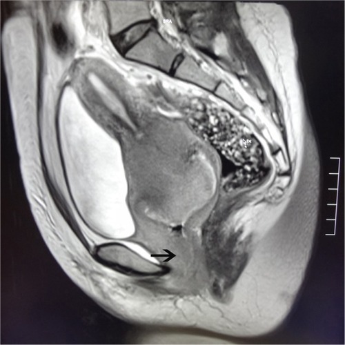 Figure 1 Magnetic resonance imaging scan showing a space-occupying lesion in the cervix that is invading the vagina (arrow).