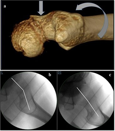 Figure 8 Pre- and post-reduction of femoral neck fracture angulation. (a) shows fracture reduction method performed on a fracture table by internal rotation and traction with gentle application of anteroposterior pressure on the femoral neck if needed, (b) shows prereduction tilt on plain film, (c) shows postoperative correction of the tilt achieved by the procedure described.