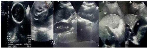 Figure 1 Abdominal ultrasonography of young adult pregnant female presenting with hematemesis showed cirrhotic liver with moderate ascites and intrauterine pregnancy.