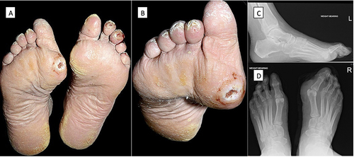 Figure 1 Classical neuropathic foot ulceration (A) with deformity-related ulcer on the right 1st metatarsophalangeal joint (MTPJ), more evident in (B). Note the claw toe deformities (C) and the downward subluxation of the right 1st MTPJ (D). In image (A), pressure ulceration of the left toes is also visible.