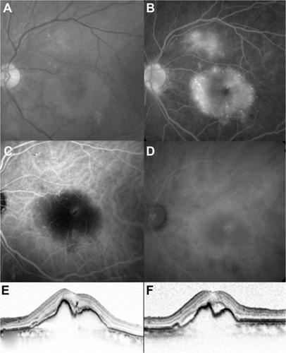 Figure 1 A 78-year-old man was treated with an intravitreal aflibercept injection. At baseline, the best-corrected visual acuity was 20/25. (A) Red-free photograph showing a pigment epithelial detachment, lipid, and serous retinal detachment at the macular area. (B) Fluorescein angiography image showing leakage due to occult choroidal neovascularization and a fibrovascular pigment epithelial detachment, as well as an occlusion of branch retinal vein and collaterals at the upper macula. (C and D) Early-phase (left) and late-phase (right) indocyanine green angiography showing no polypoidal lesion. (E and F) Baseline horizontal (left) and vertical (right) optical coherence tomography (Spectralis®; Heidelberg Engineering, Heidelberg, Germany) images showing a serous retinal detachment and fibrovascular pigment epithelial detachment.