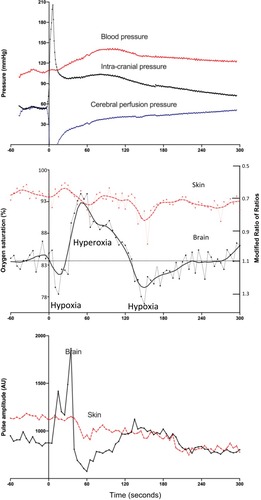 Figure 4 Responses to the third injection of blood into the cranial vault. Top panel: intracranial, blood and cerebral perfusion pressures: The injection caused an immediate increase in the intracranial pressure and drop in cerebral perfusion pressure. Blood pressure increased by 60 s and intracranial pressure fell, leading to a recovery in cerebral perfusion pressure. Middle panel: brain and skin pulse oximeter oxygen levels: the fall in cerebral perfusion pressure was associated with a fall in brain oxygen saturation to 78%. The recovery in cerebral perfusion pressure was associated with an increase in brain oxygen saturation to 94% at 60 s. A further fall in brain oxygen saturation to 77% occurred at 150 s. Skin oxygen levels remained stable. Bottom panel: brain and skin pulse oximeter pulse amplitude levels: The amplitude of the brain oximeter pulse demonstrated a marked increase, but not with the conventional skin pulse oximeter, following the injection. The oxygen saturations represent the average microvascular oxygen level over the entire cardiac cycle for each pulse. Pulse oximetry data represent the average for 7 sheep. The pressure data represent the average for 5 sheep. Each cranial vault injection commenced at time = 0.