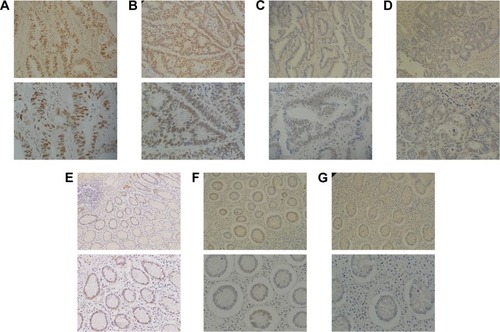Figure 1 Representative micrographs of the staining patterns of CDKL1 in (A–D) CRC and (E–G) normal mucosa.