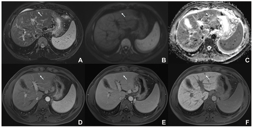 Figure 2 A 7.3mm pathologically proven HCC in a 62-year-old man with hepatitis B virus infection. Axial T2-weighted images reveal a nodule (arrow) with mild hyperintensity in S2 of the liver (A). This nodule exhibit restricted diffusion (arrow) in DWI (b = 500 seconds/mm2) and ADC (B and C), homogeneous hyperenhancement (arrow) on arterial phase (D), nonperipheral washout (arrow) on portal venous phase (E), and hypointensity (arrow) on hepatobiliary phase (F). Pathologic evaluation for resected specimen demonstrated an Edmondson grade II HCC without microvascular invasion. During a follow-up period of 96.5 months, no recurrence occurred.