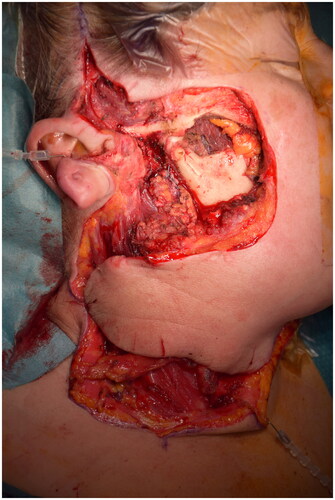 Figure 1. Radical resection residual defect and cheek flap which is rotating to restore the cheek area.