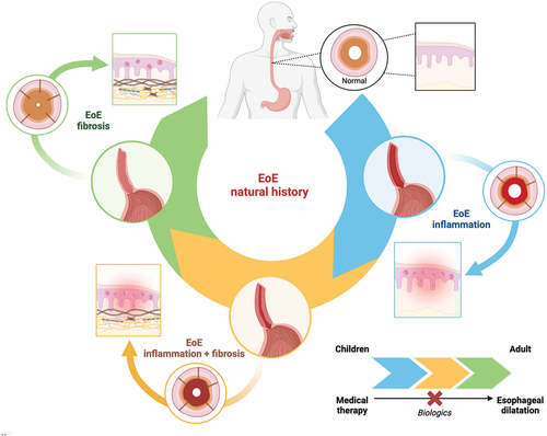 Figure 1. The natural history of EoE is characterized by different stages, from an inflammatory one (rich in eosinophils, among other cellular types,), to a stage where inflammation is present together with fibrosis and finally to a mainly fibrotic stage (with a reduced inflammatory infiltrate), leading to stenosis and small caliper esophagus, as depicted in the Figure by means of different colors (upper part of the figure). The squared inset depicts histological changes, while the circular ones the sagittal and transversal view of the esophagus. The transition from one stage to the other is influenced by the duration of the disease and related diagnostic delay and age of the patient, and treatment, (lower part of the figure). According to the different stage of the disease, a specific treatment modality may be more appropriate from medical therapy to mechanical dilation. As shown, biological therapy can alter the progression.