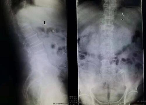 Figure 1 Preoperative X-ray showed collapsed vertebral body and fractures in the vertebral body.