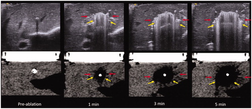 Figure 6. US (top) vs. CT (bottom) intra-procedure images of MW ablation. Yellow arrows describe the zone of gas while red arrows indicate the hypoechoic/hypodense zone. Note the easy visibility of gas within the ablation zone on both ultrasound and CT while the hypodense zone is subtle, particularly on CT. These images also demonstrate the continually visible growth of the zone of out-gassing.