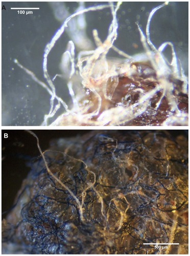 Figure 1 (A) Callus collected from patient 1. Note hyaline filaments projecting from callus. 100× magnification. (B) Callus removed from patient 2. Note blue and hyaline filaments projecting from callus surface. 40× magnification. (C) Gross microscopic view of callus removed from patient 3. Note blue filaments embedded in callus external surface. 8× magnification. (D) Callus from patient 2 demonstrating protruding keratin projections on internal surface. Note clear ingrown hair (arrow). 100× magnification.