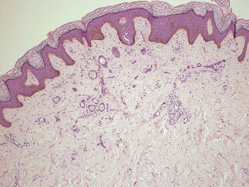 Figure 3 Representative lesion of an eruptively disseminating syringomatosis (patient #3), H&E, ×100.