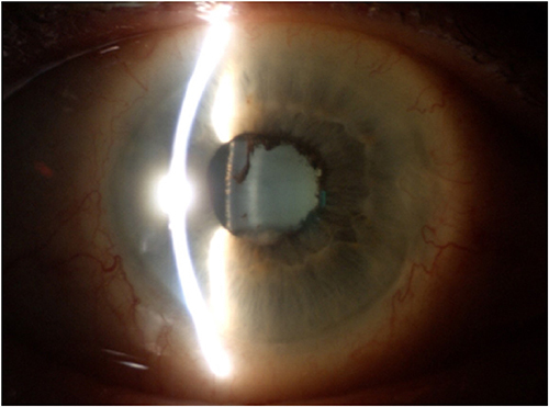 Figure 5 Uveitis during COVID-19 in a 48-year-old female patient (Picture from the collection of the Ophthalmology Department, Medical University of Bialystok).