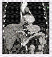 Figure 2. Computed tomography scan showing a low attenuation mass in the head of the pancreas.