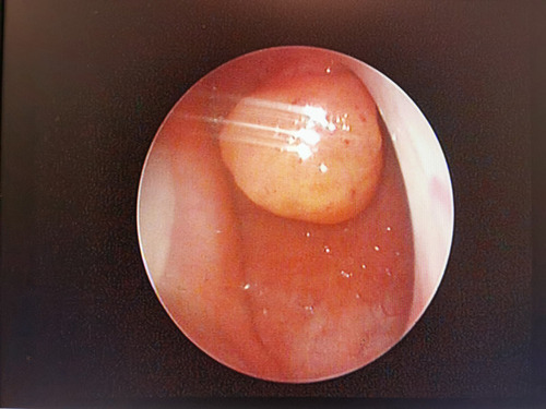 Figure 2 Nasopharyngeal endoscopy revealed a pedicled polypoid mass was located on the root of the nasopharynx.