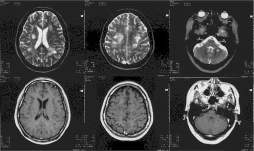 Fig. 2 In the 5th week after disease onset, repeated brain MRIs: the original lesion had become more clear, the brain swelling had disappeared, most of the lesions exhibited no enhancement, and individual lesions with mild small patchy enhancements remained present but with significantly reduced signal intensities.