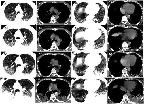 Figure 5. Evolution of the mixed pattern on chest CT of patients with COVID-19. A 64-year-old male Wuhan resident presented with cough, fever, and fatiguefor 3 days. (A1–A4) The first non-contrast-enhanced chest CT scan reveals multiple ground-glass opacities (GGO), fibrous stripes and visible interlobular septal thickening in the left and right upper and lower lobes (initial chest CT). (B1–B4) Follow-up chest CT 4 days after the first shows that both the scope and density of the lesions increase (stage I*). (C1–C4) Follow-up chest CT 8 days after the first shows that both the scope and density of the lesions increase further (stage II*). (D1–D4) Follow-up chest CT 12 days after the first shows that both the scope and density of the lesions increase even further (stage III*). *The stage does not represent the course of COVID-19 but the time interval between the two adjacent CT scans.