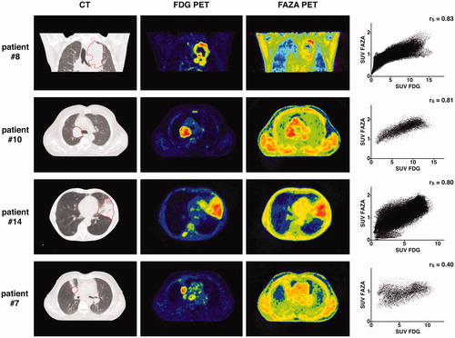 Figure 2. For four different patients, the panels display from left to right: (1) the pre-treatment CT scan (the GTVCT is delineated with a red line); (2) the pre-treatment FDG PET scan; (3) the pre-treatment FAZA PET scan and; (4) the voxel-by-voxel scatter plot showing the relation between FDG and FAZA PET uptake values within GTVCT. FAZA PET images constantly display lower tumour-to-background ratio than FDG. The three upper panels correspond to tumours with relatively high FAZA uptake, in which FDG and FAZA intratumoral uptake distributions show good correlation. The lower panel displays a tumour which FAZA uptake does not exceed the background, and shows low similarity with FDG.